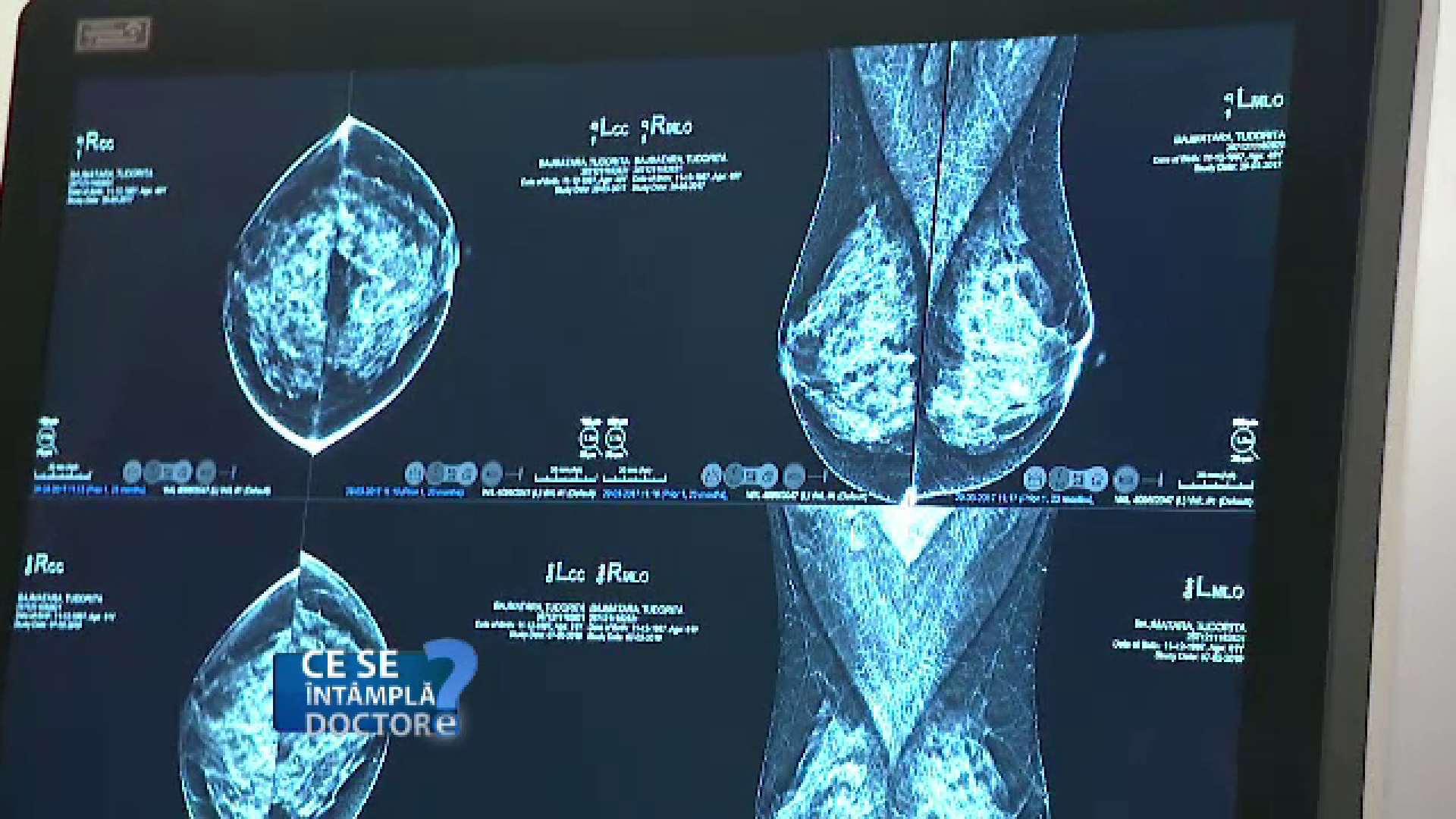 Riscurile pe care le ascunde un sân dens Medicii recomandă ecografie