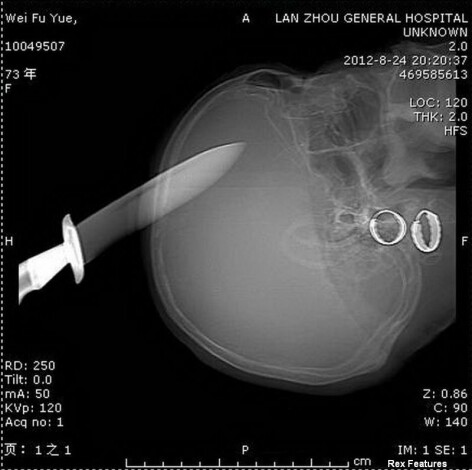 Radiografie cutit