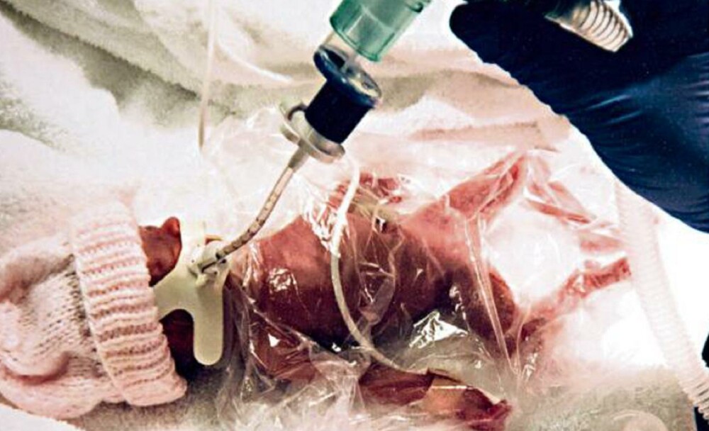 Avea doar 500 de grame cand s-a nascut, medicii nu i-au dat nicio sansa, dar fetita tocmai a implinit un an. Cum arata. FOTO - Imaginea 1