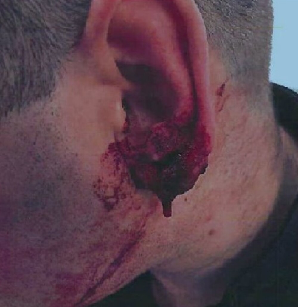 Cum arată un polițist, după ce a fost mușcat de ureche de un hoț. Ce a pățit agresorul - Imaginea 3