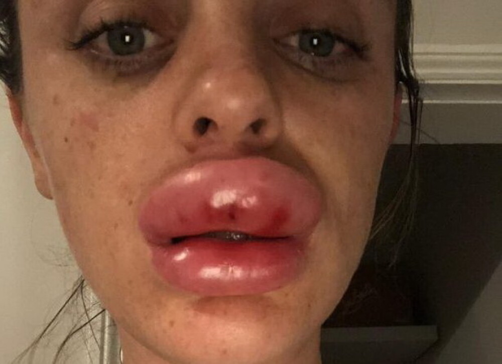 Tânără desfigurată după ce și-a mărit buzele la o petrecere. Ce a aflat la spital - Imaginea 1