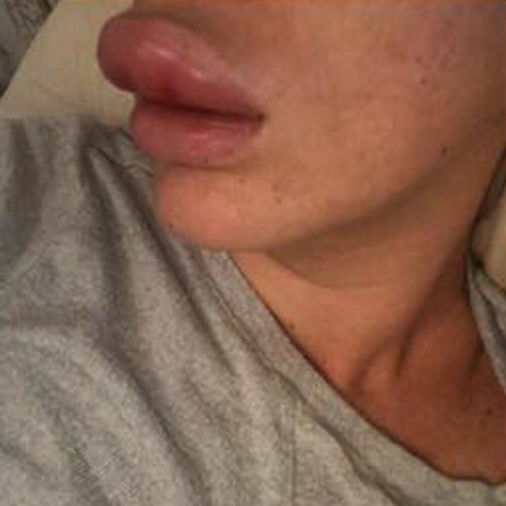 Tânără desfigurată după ce și-a mărit buzele la o petrecere. Ce a aflat la spital - Imaginea 2