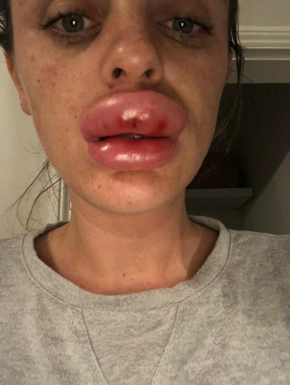 Tânără desfigurată după ce și-a mărit buzele la o petrecere. Ce a aflat la spital - Imaginea 4