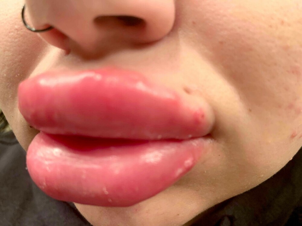Cum arată o femeie după ce și-a făcut o operație estetică. Se teme că „îi vor pica” buzele - Imaginea 10
