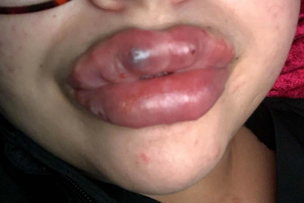 Cum arată o femeie după ce și-a făcut o operație estetică. Se teme că „îi vor pica” buzele - Imaginea 9