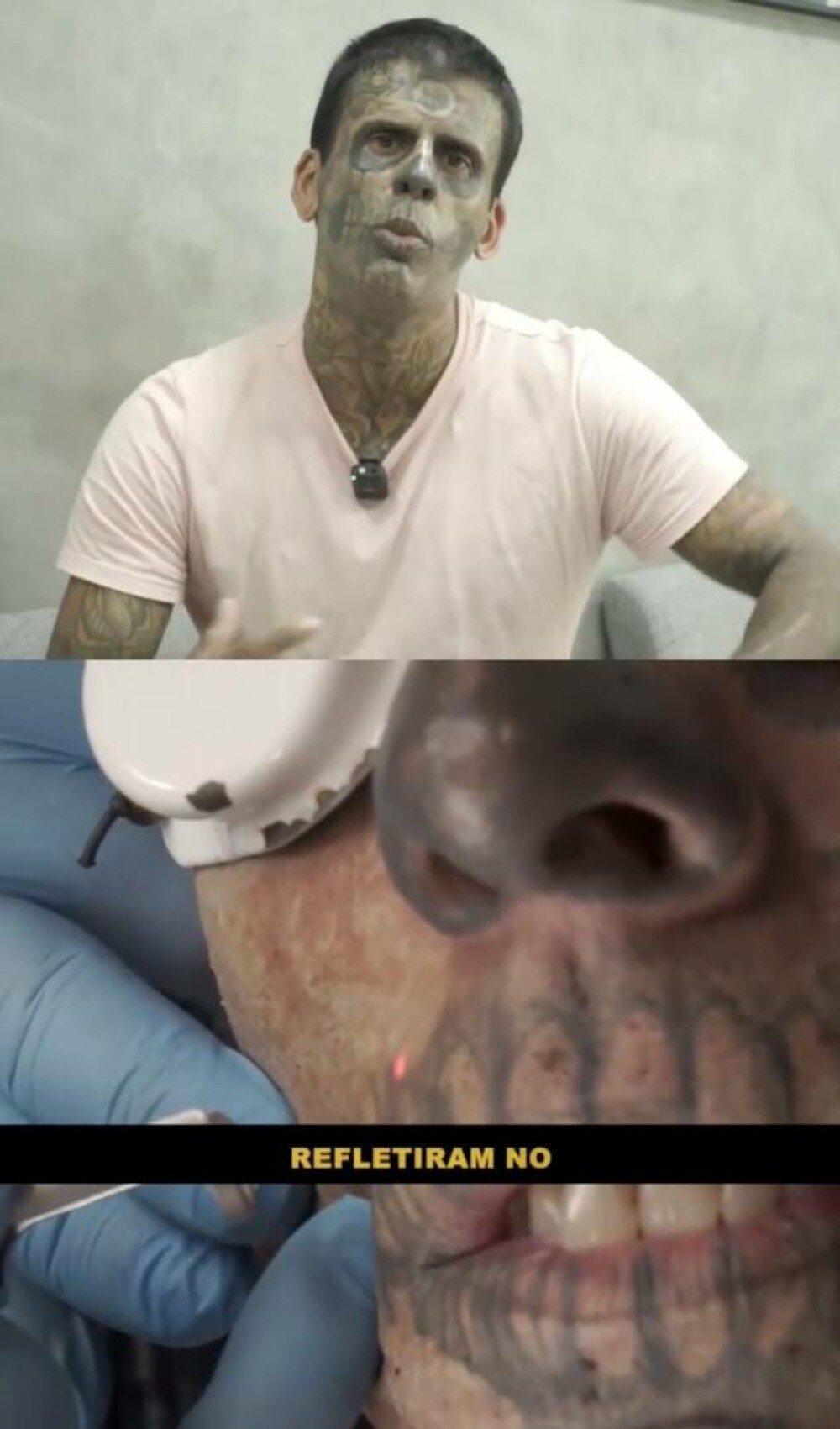 Un bărbat care și-a tatuat 95% din corp dezvăluie cum arată după cinci intervenții de îndepărtare a tatuajelor. FOTO - Imaginea 2