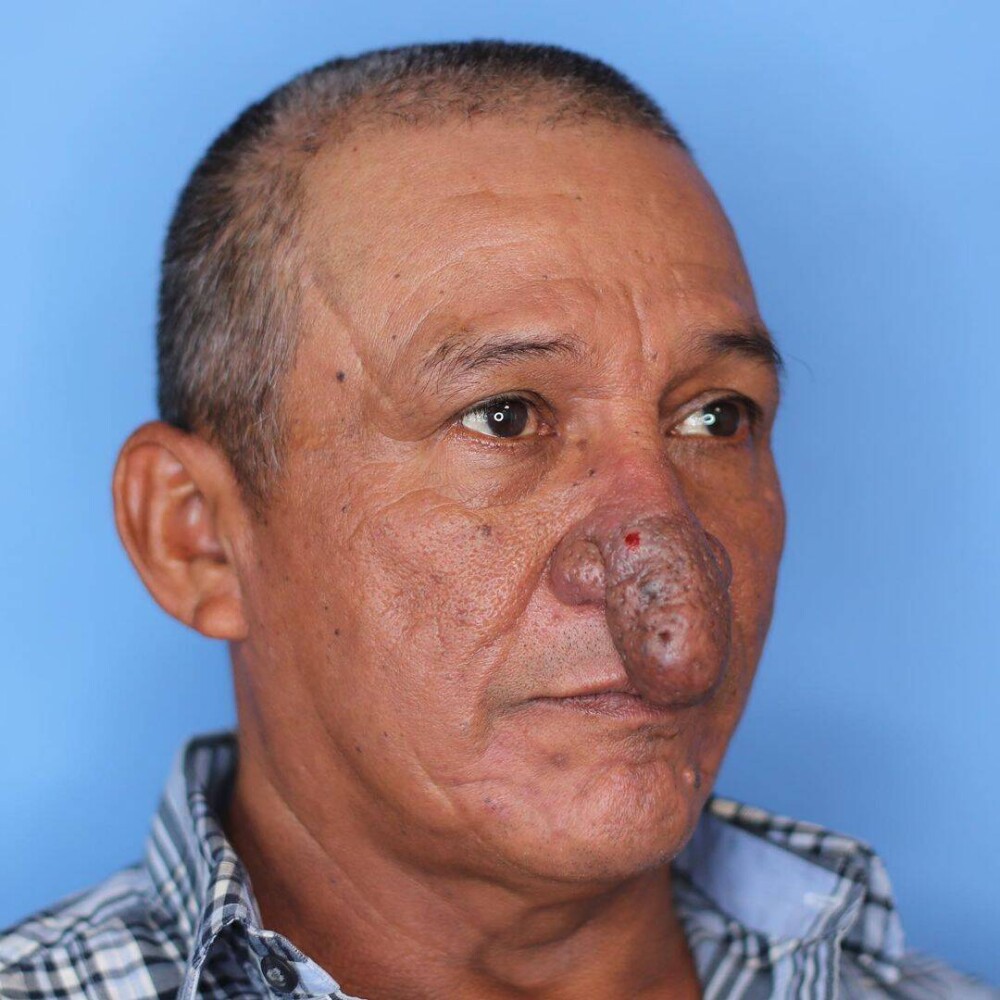 FOTO Transformarea incredibilă a unui bărbat căruia nasul i-a crescut exagerat de mult: „Îmi ajungea la buze” - Imaginea 1