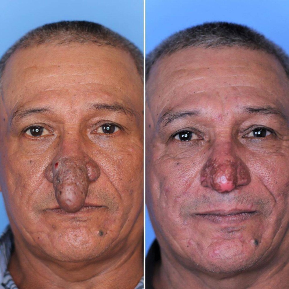 FOTO Transformarea incredibilă a unui bărbat căruia nasul i-a crescut exagerat de mult: „Îmi ajungea la buze” - Imaginea 9