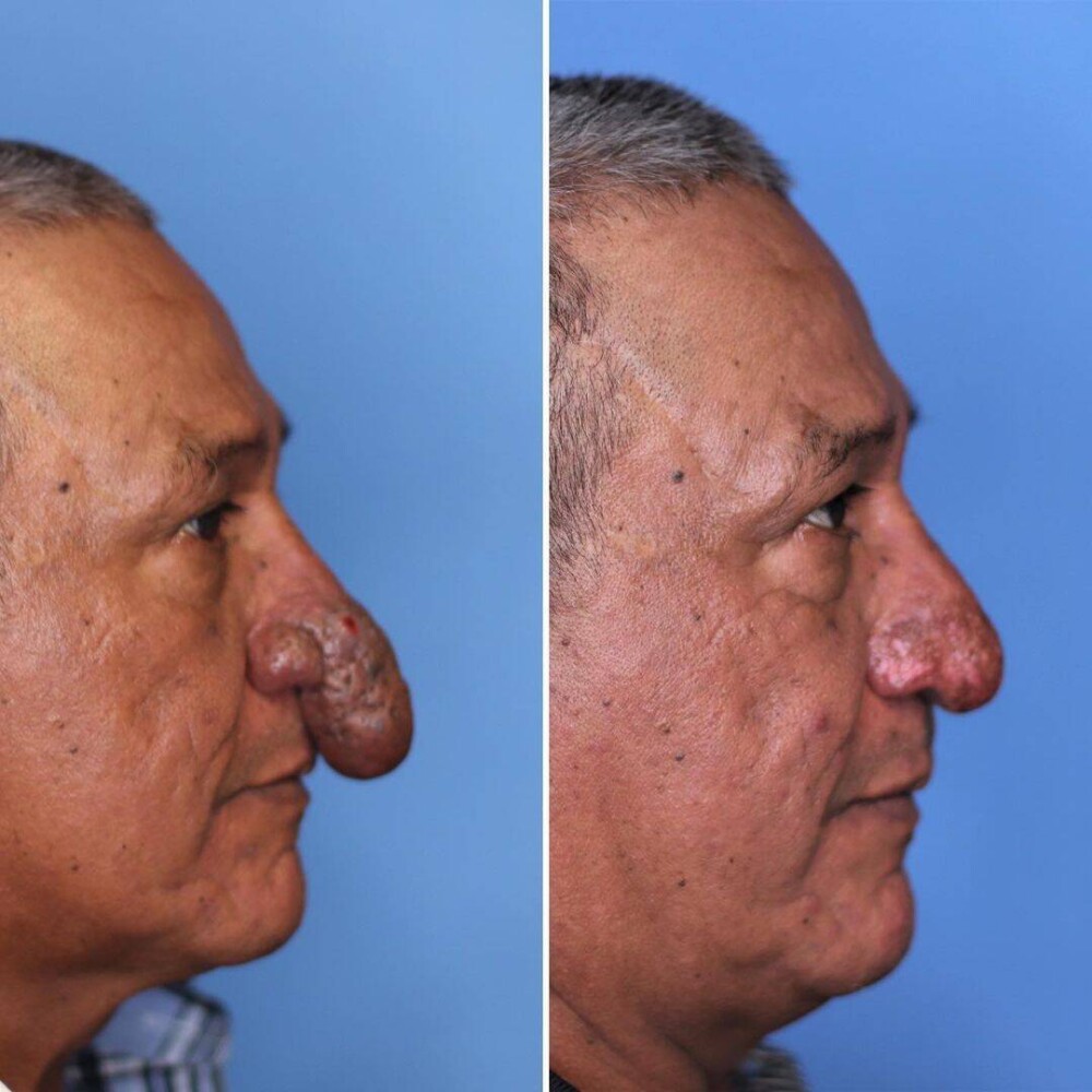 FOTO Transformarea incredibilă a unui bărbat căruia nasul i-a crescut exagerat de mult: „Îmi ajungea la buze” - Imaginea 7