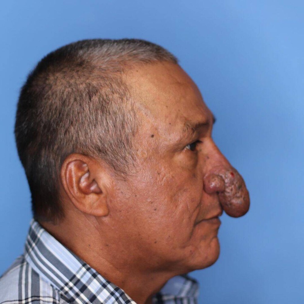 FOTO Transformarea incredibilă a unui bărbat căruia nasul i-a crescut exagerat de mult: „Îmi ajungea la buze” - Imaginea 6
