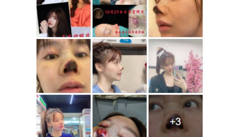 O actriță celebră din China are nasul distrus după o operație greșită. „A necrozat” - Imaginea 3