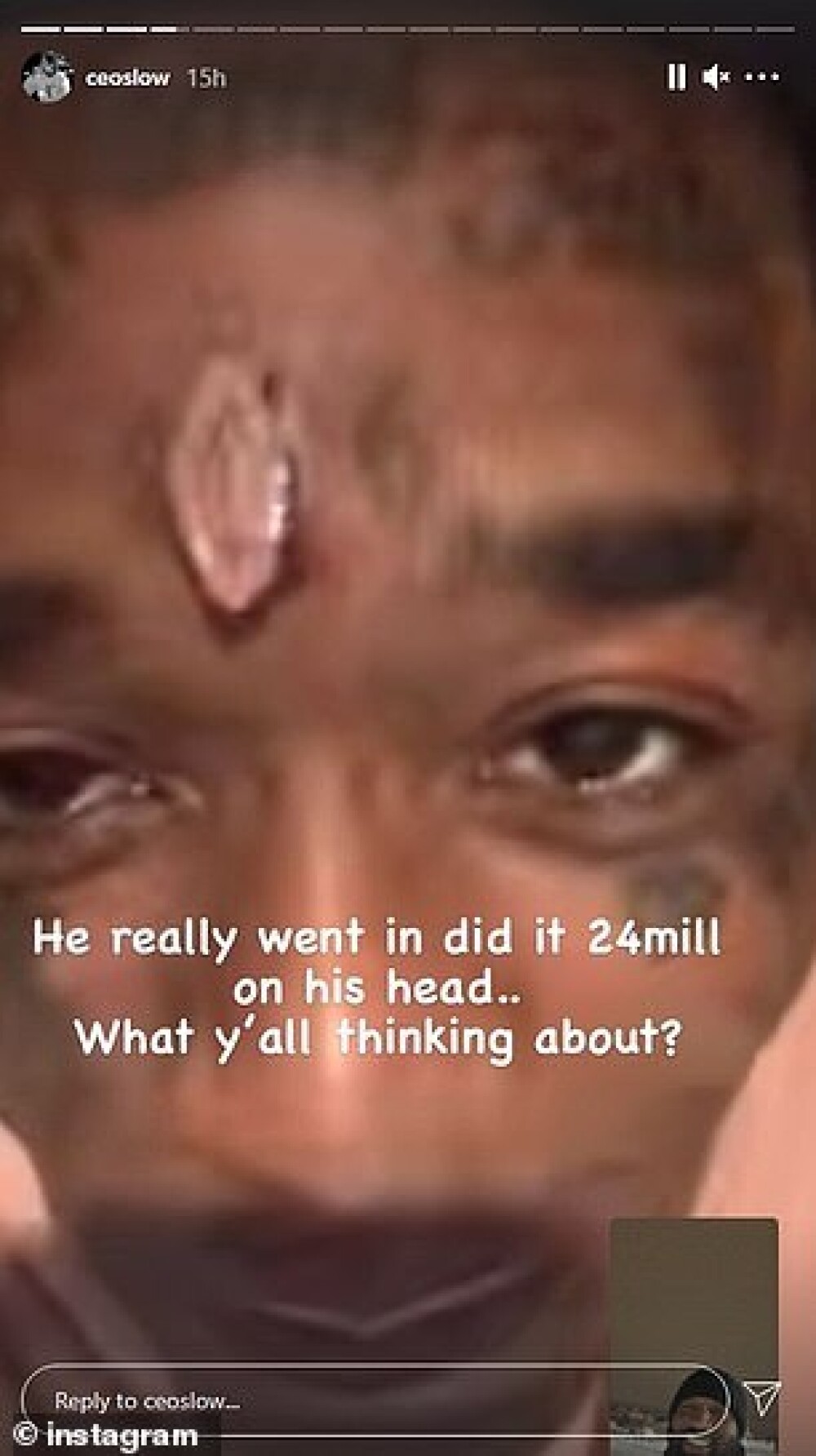 Rapperul Lil Uzi Vert și-a pus în frunte un diamant roz de 24 de milioane de dolari. FOTO - Imaginea 2
