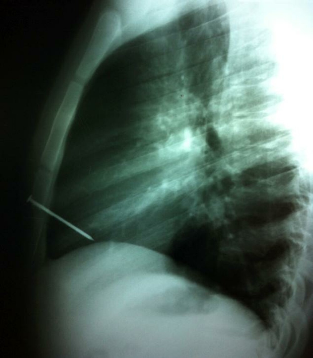 Medicii au inmarmurit cand au vazut radiografia. “Doar 3 oameni au supravietuit unei astfel de rani