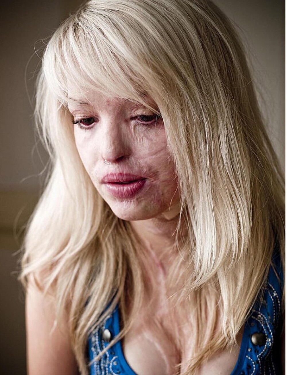 Aceasta femeie poate zambi din nou, dupa atacul care a desfigurat-o. Cum arata dupa 100 de operatii - Imaginea 1