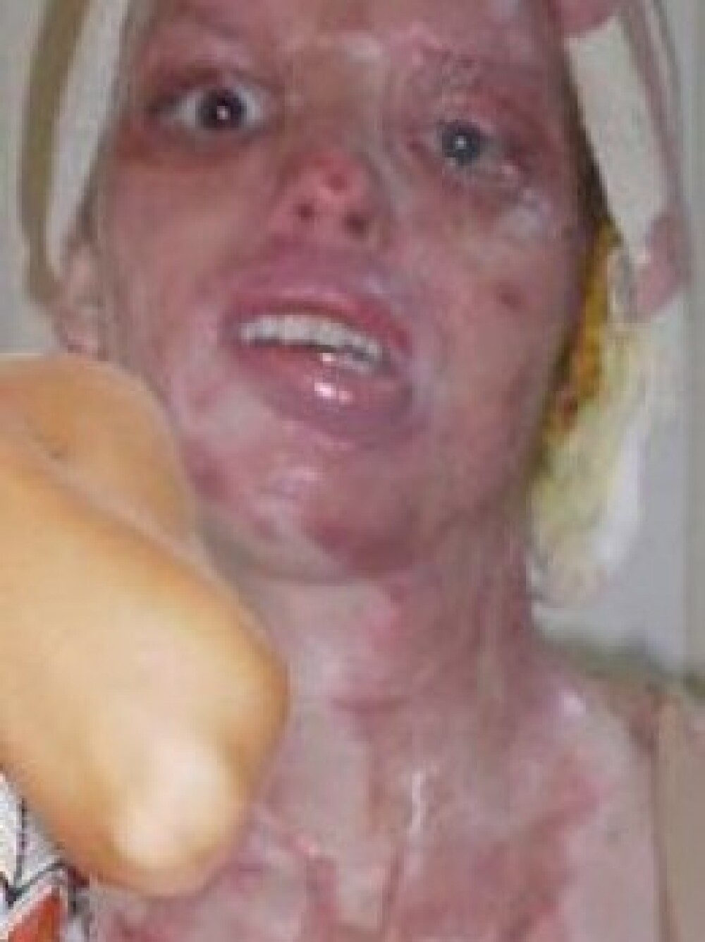 Aceasta femeie poate zambi din nou, dupa atacul care a desfigurat-o. Cum arata dupa 100 de operatii - Imaginea 2