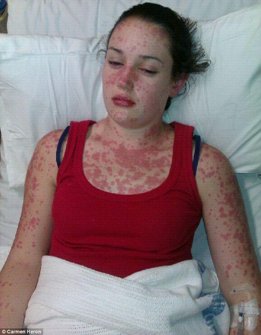 Reactia alergica la un medicament a transformat-o intr-o mumie. Cum arata tanara de 19 ani inainte de boala - Imaginea 3