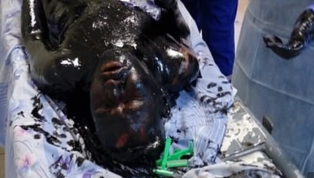 Pățania unui bărbat care a căzut într-o groapă imensă, plină cu smoală. Cum arată acum. FOTO - Imaginea 2