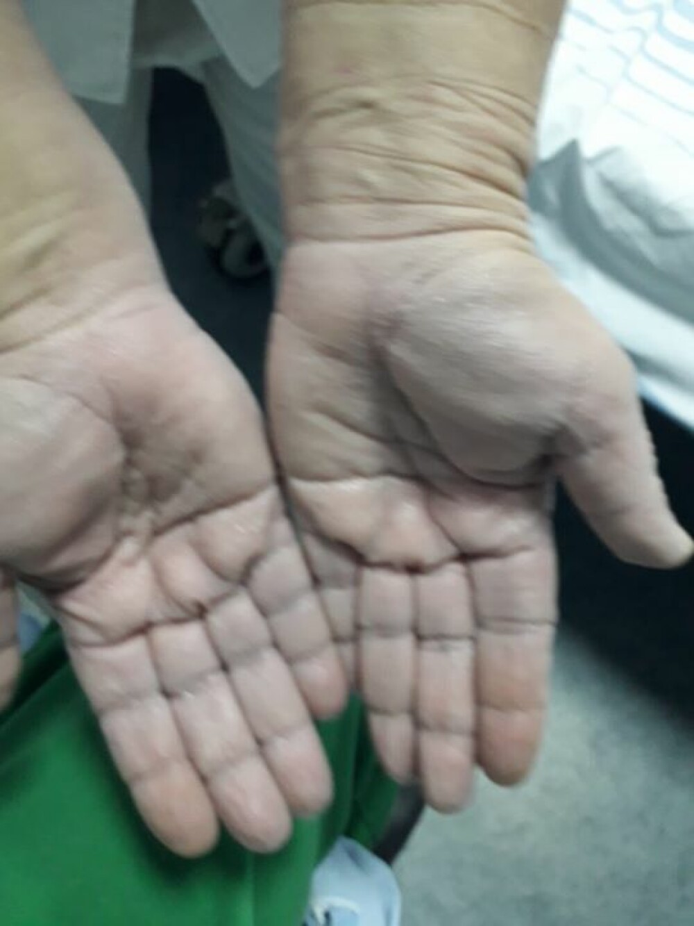Imagini greu de privit cu medicii care poartă combinezoane anti Covid-19. Cum arată mâinile lor - Imaginea 2