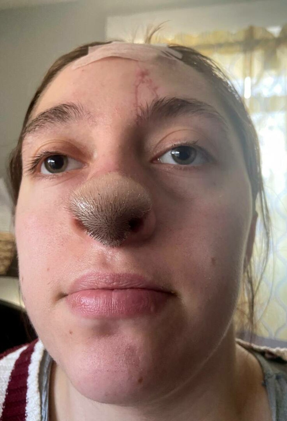 O femeie a rămas uimită când a început să-i crească păr pe nas, după o operație de reconstrucție. GALERIE FOTO - Imaginea 2