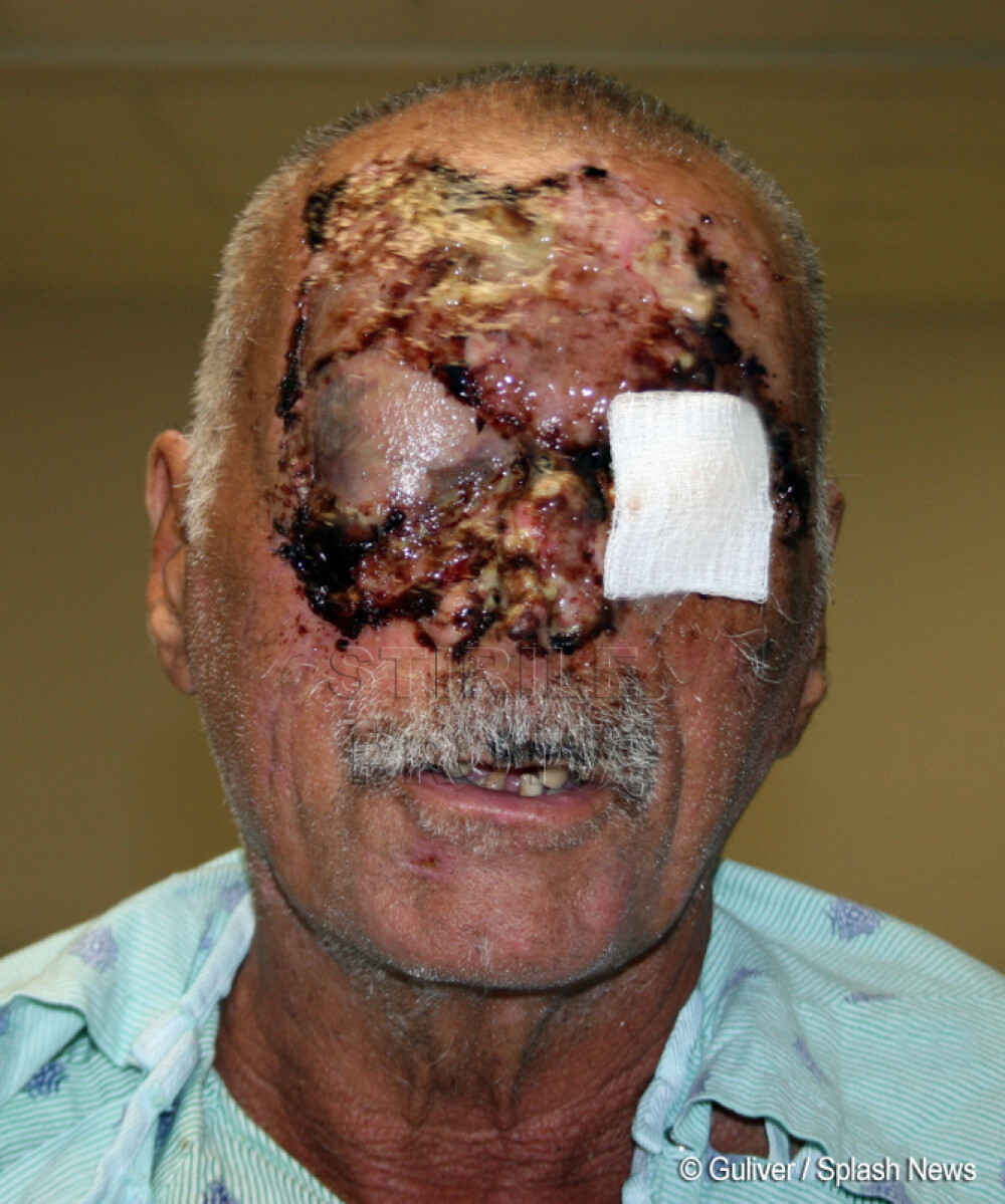 Fotografiat in spital: Primele IMAGINI cu barbatul devorat de canibalul din Miami - Imaginea 3