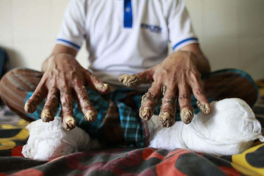 Un bărbat le-a cerut medicilor să-i taie mâinile, ca să poată dormi. Boala de care suferă - Imaginea 1