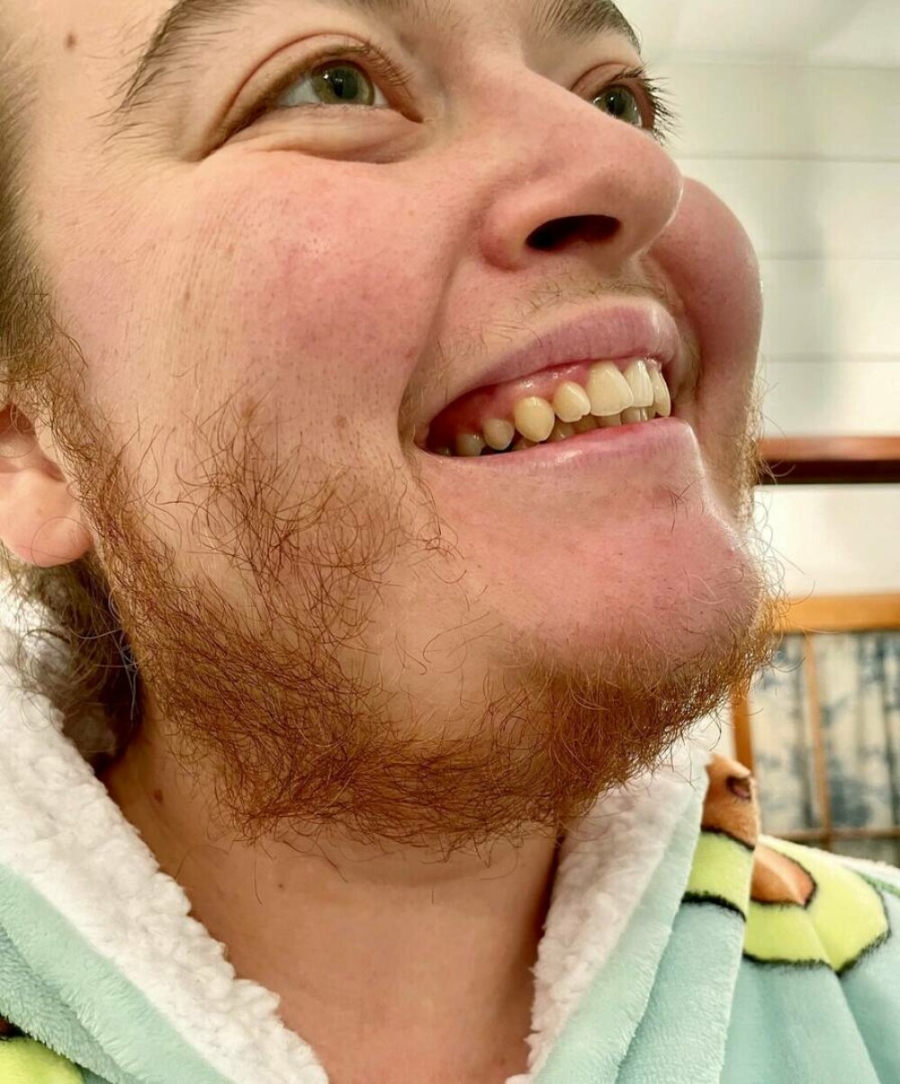 GALERIE FOTO După ani de chin, o tânără a decis să renunțe la lama de ras și să-și lase barba să crească. Cum arată acum - Imaginea 6