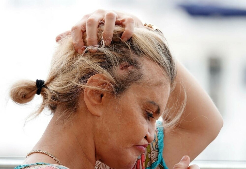 Are o gaură în cap. O celebră actriță a rămas mutilată după operațiile estetice: „M-a cusut cu fire de pescuit” | FOTO - Imaginea 13