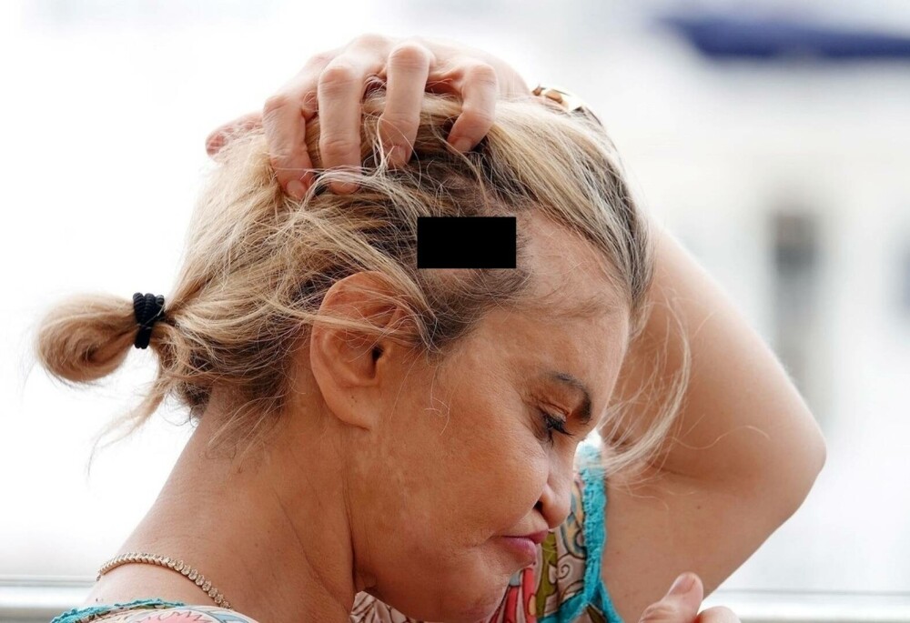 Are o gaură în cap. O celebră actriță a rămas mutilată după operațiile estetice: „M-a cusut cu fire de pescuit” | FOTO - Imaginea 1