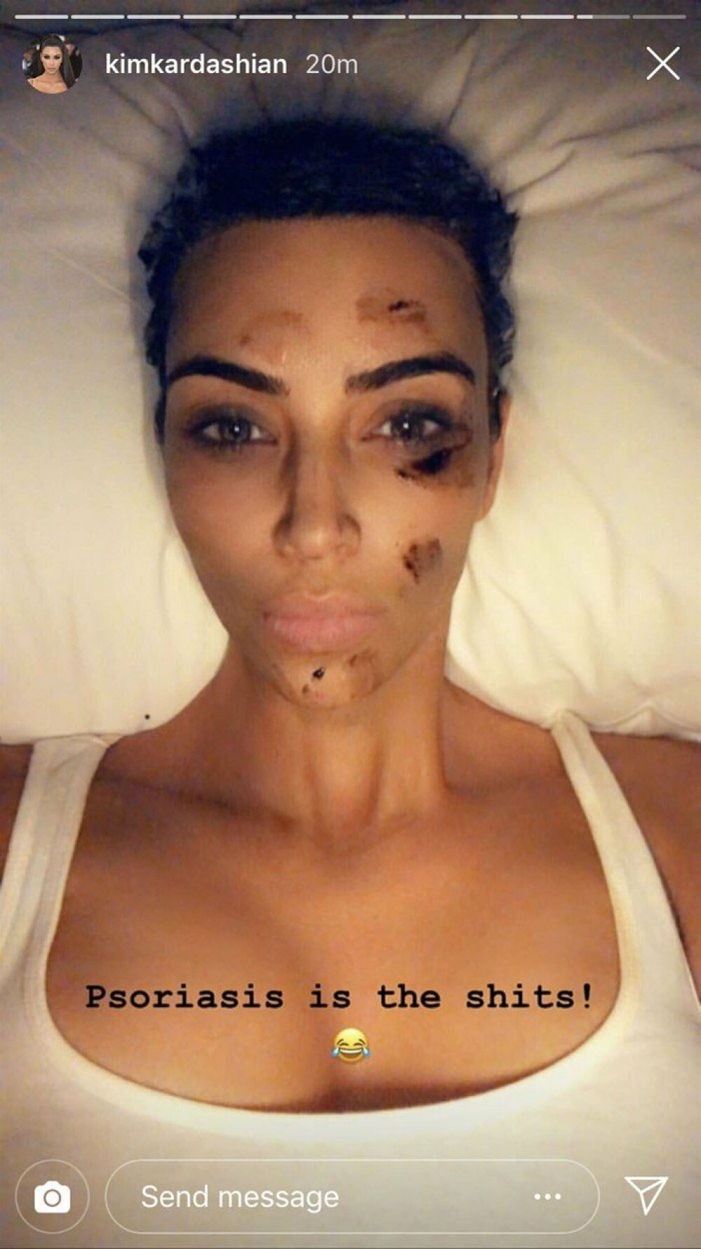 Kim Kardashian a dezvăluit că o boală gravă îi afectează chipul. GALERIE FOTO - Imaginea 2
