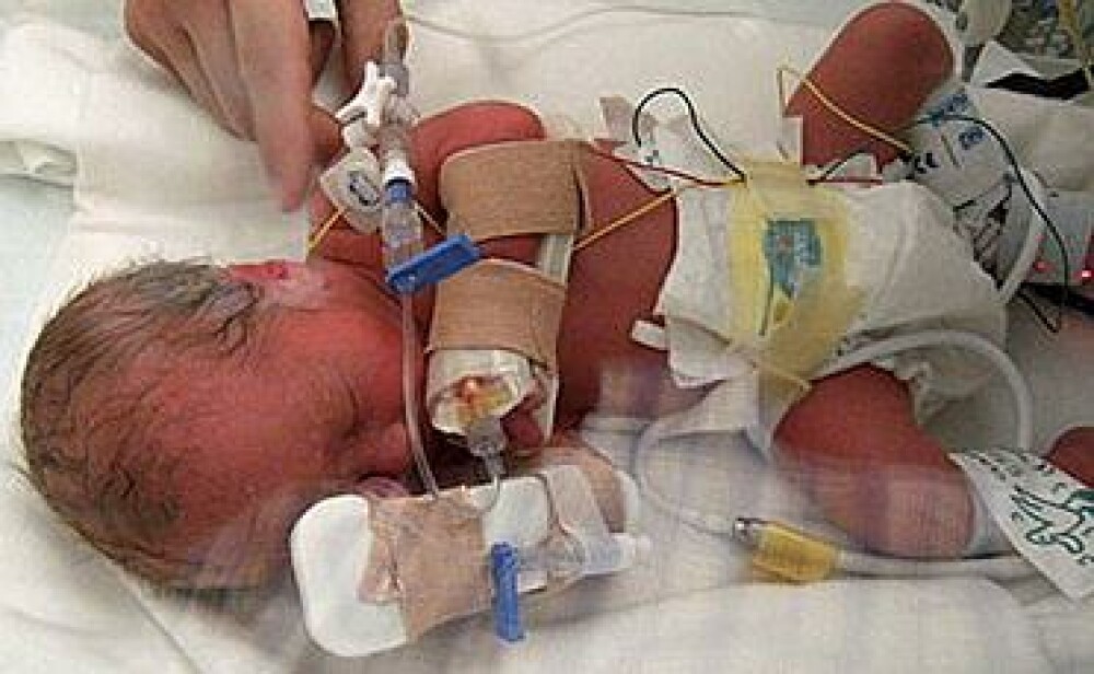 Incredibil!Bebelus salvat, dupa ce medicii i-au lipit o artera cu superglue - Imaginea 2