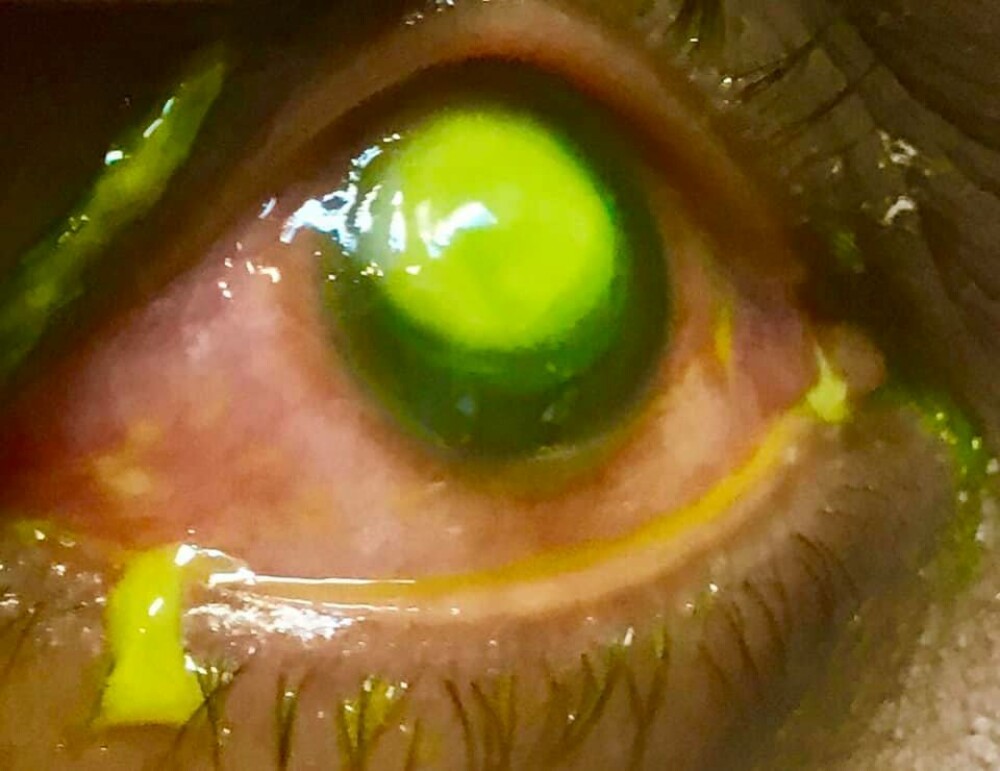 Avertismentul unui oftalmolog legat de un obicei greșit, des întâlnit: ”Riscați orbirea permanentă” - Imaginea 7