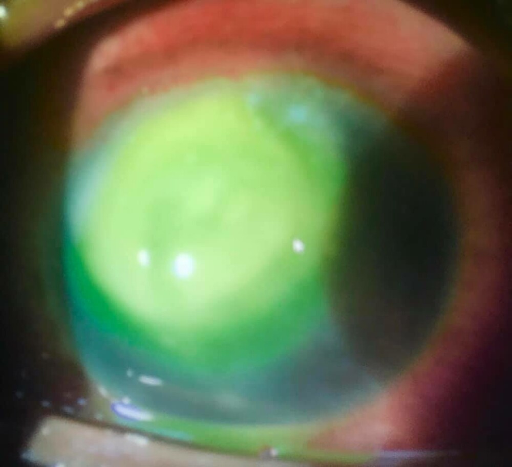 Avertismentul unui oftalmolog legat de un obicei greșit, des întâlnit: ”Riscați orbirea permanentă” - Imaginea 2