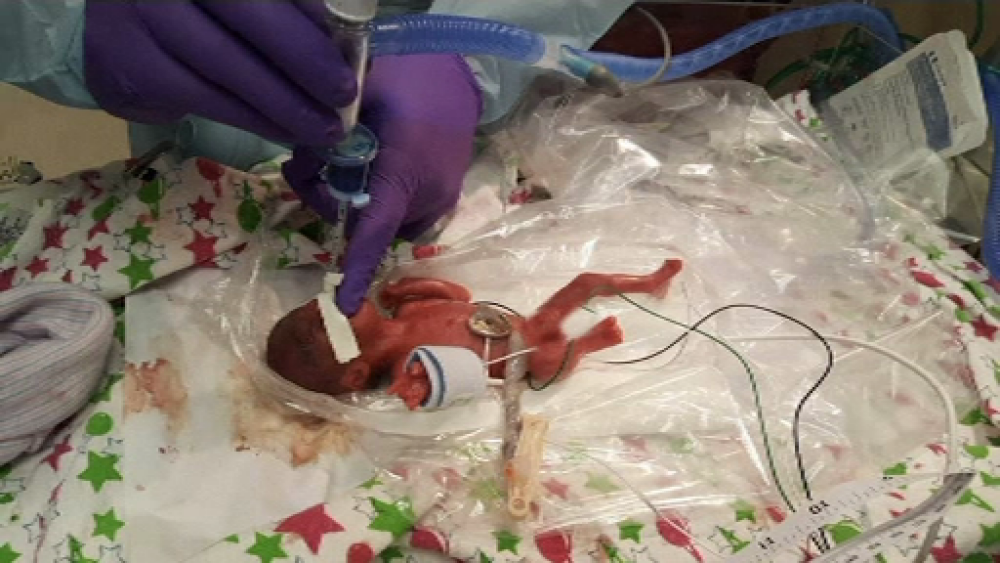 Cel mai mic bebeluş din lume, născut la 245 de grame, a fost externat - Imaginea 4