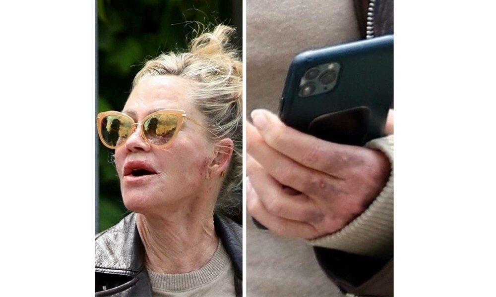 Actrița Melanie Griffith, apariție îngrijorătoare. A fost văzută cu răni pe față și vânătăi pe mâini | GALERIE FOTO - Imaginea 1