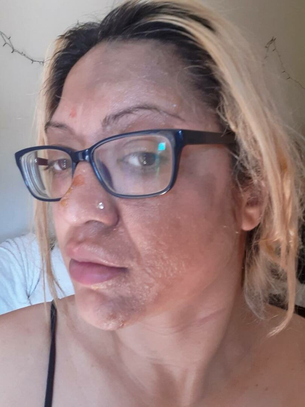 O femeie s-a ales cu jumătate de față arsă după ce a încercat un truc viral pe TikTok. „Am fost într-o agonie absolută” - Imaginea 1