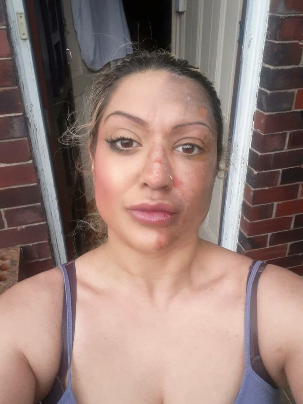 O femeie s-a ales cu jumătate de față arsă după ce a încercat un truc viral pe TikTok. „Am fost într-o agonie absolută” - Imaginea 2