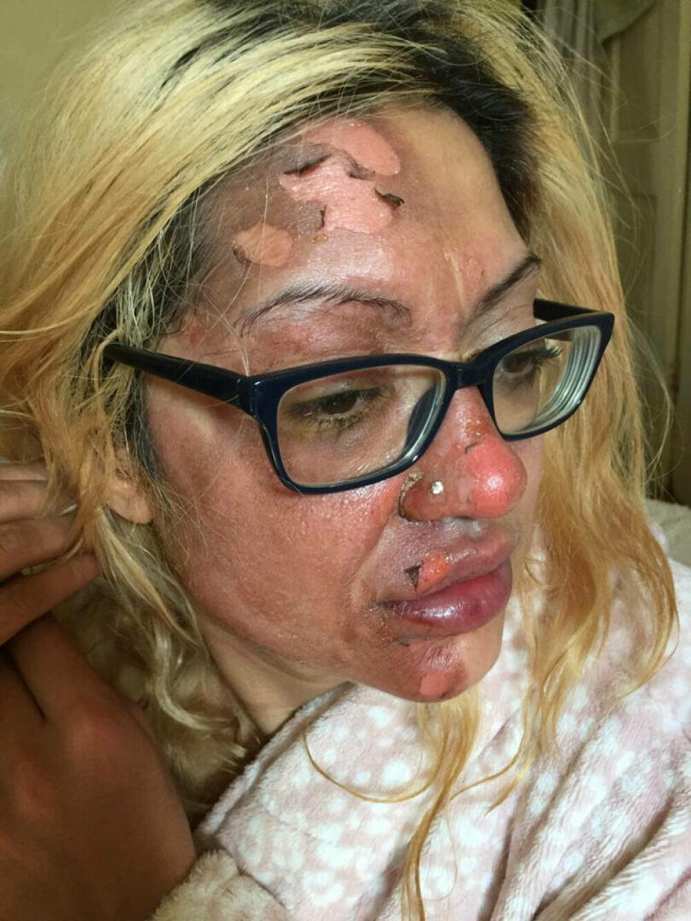 O femeie s-a ales cu jumătate de față arsă după ce a încercat un truc viral pe TikTok. „Am fost într-o agonie absolută” - Imaginea 3