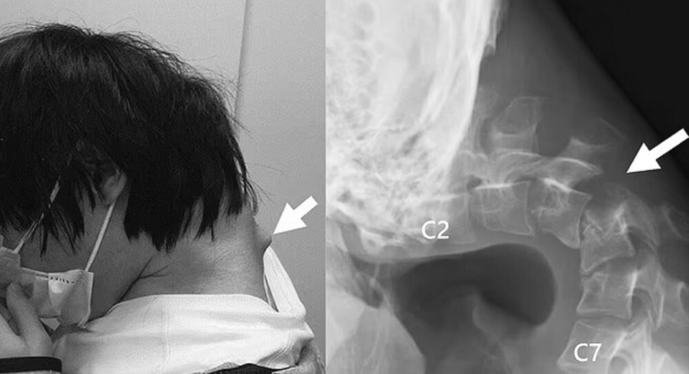 Cum i-au afectat orele petrecute în exces pe telefon sănătatea unui tânăr. Medicii trag un semnal de alarmă - Imaginea 1
