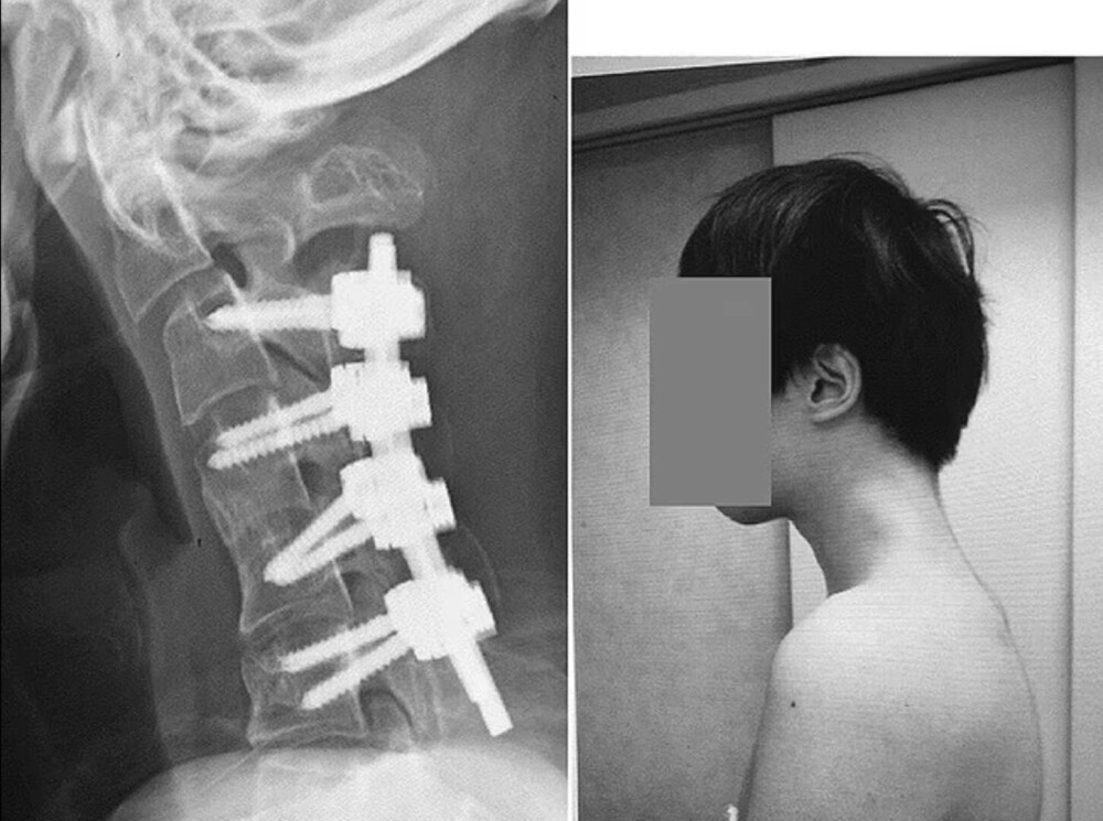 Cum i-au afectat orele petrecute în exces pe telefon sănătatea unui tânăr. Medicii trag un semnal de alarmă - Imaginea 3