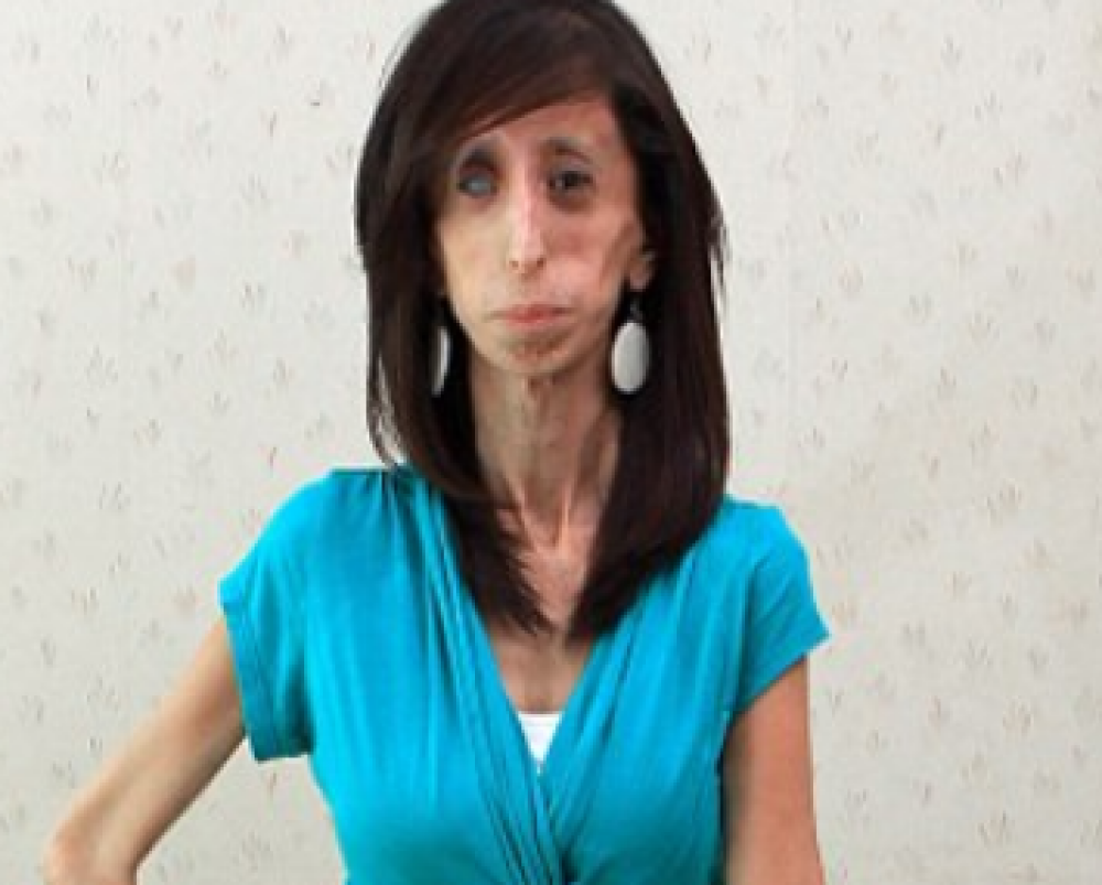 Cum arata femeia care este nevoita sa manance din 20 in 20 de minute din cauza unei boli bizare - Imaginea 3