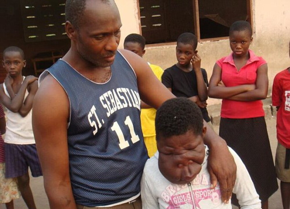 Fetita de 13 ani din Ghana cu o diformitate faciala extrema va fi operata. FOTO - Imaginea 1