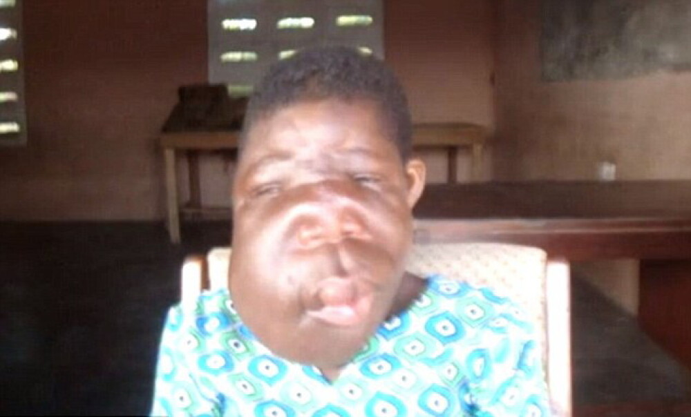 Fetita de 13 ani din Ghana cu o diformitate faciala extrema va fi operata. FOTO - Imaginea 2