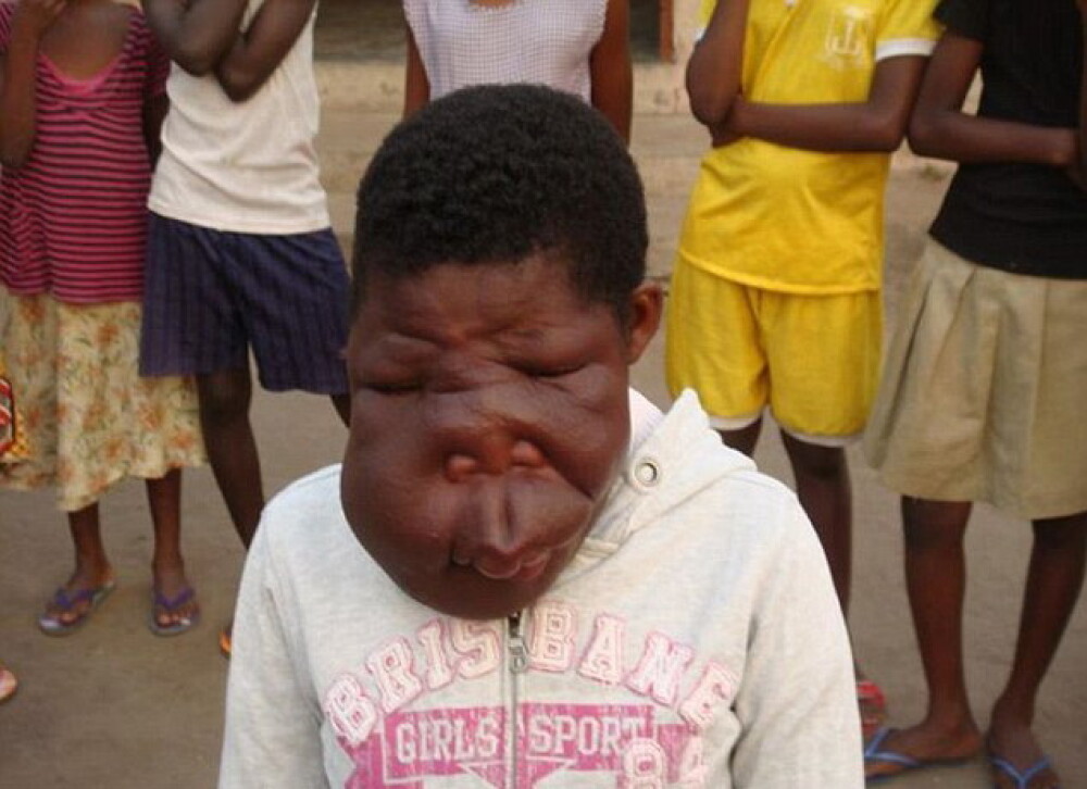 Fetita de 13 ani din Ghana cu o diformitate faciala extrema va fi operata. FOTO - Imaginea 3
