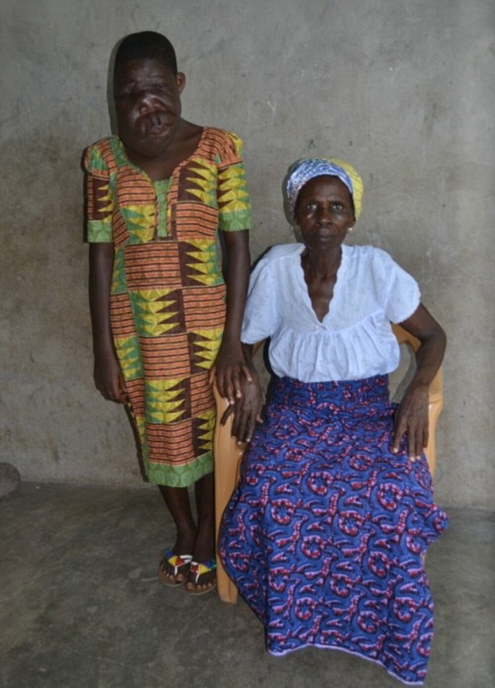 Fetita de 13 ani din Ghana cu o diformitate faciala extrema va fi operata. FOTO - Imaginea 4