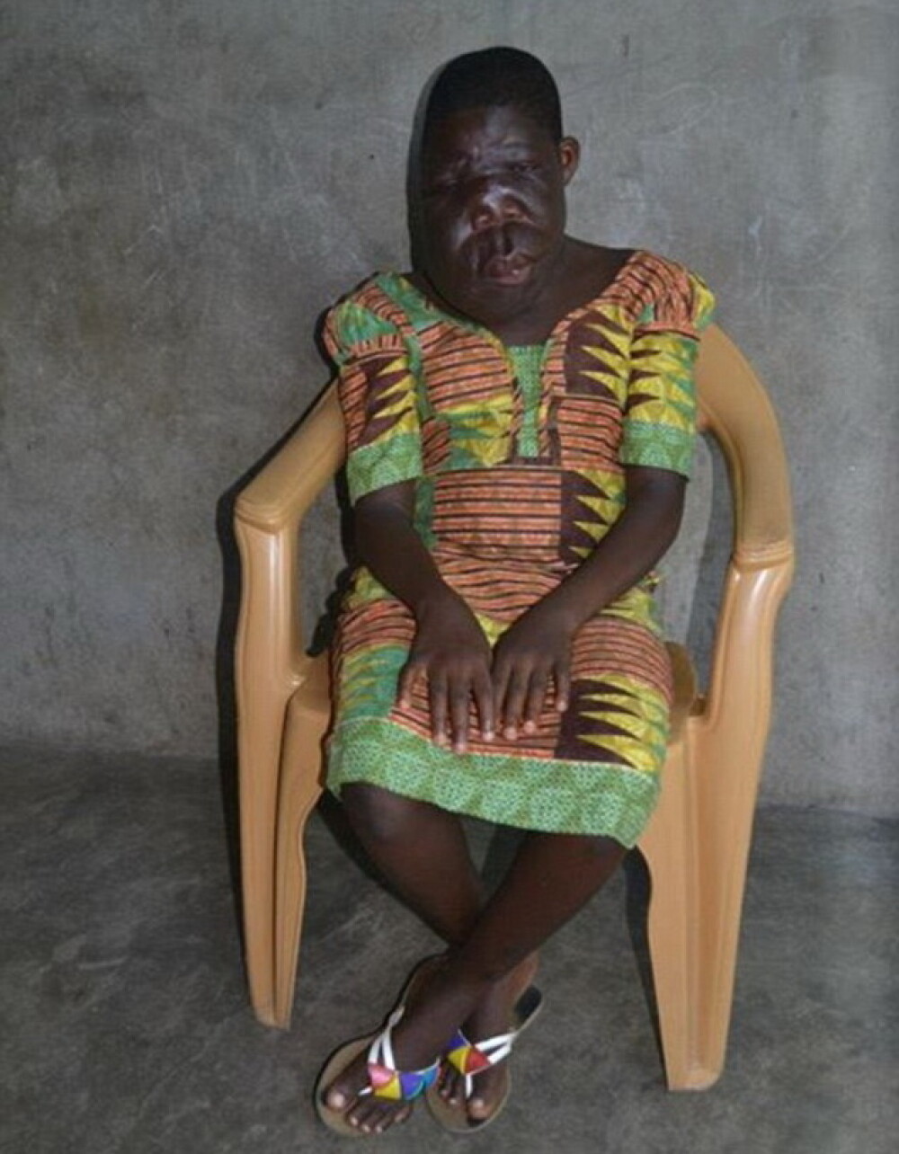 Fetita de 13 ani din Ghana cu o diformitate faciala extrema va fi operata. FOTO - Imaginea 5