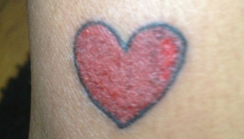 Reactia alergica violenta pe care facut-o o femeie dupa ce s-a tatuat. GALERIE FOTO - Imaginea 1