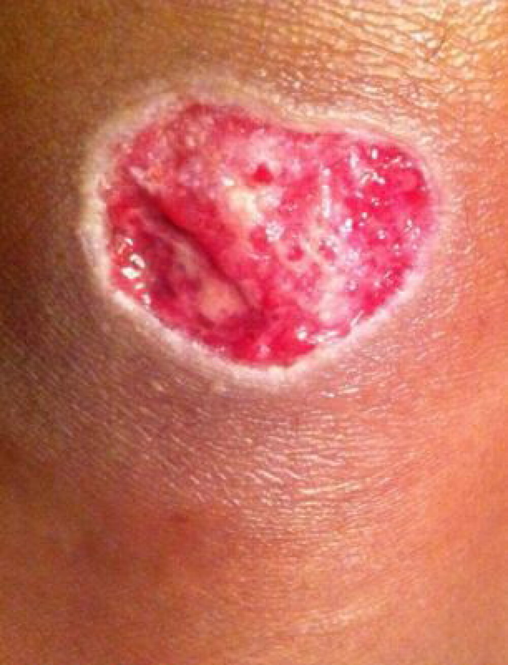 Reactia alergica violenta pe care facut-o o femeie dupa ce s-a tatuat. GALERIE FOTO - Imaginea 3