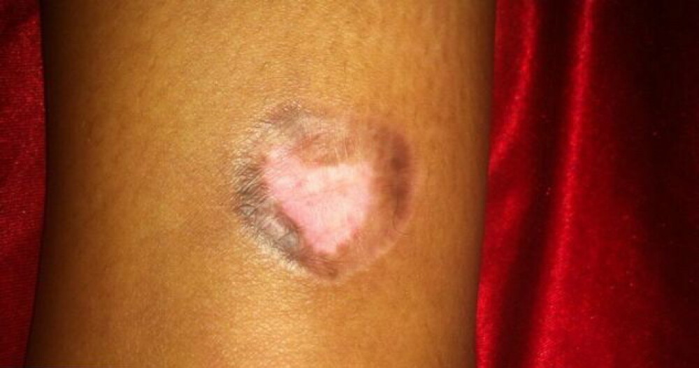 Reactia alergica violenta pe care facut-o o femeie dupa ce s-a tatuat. GALERIE FOTO - Imaginea 4