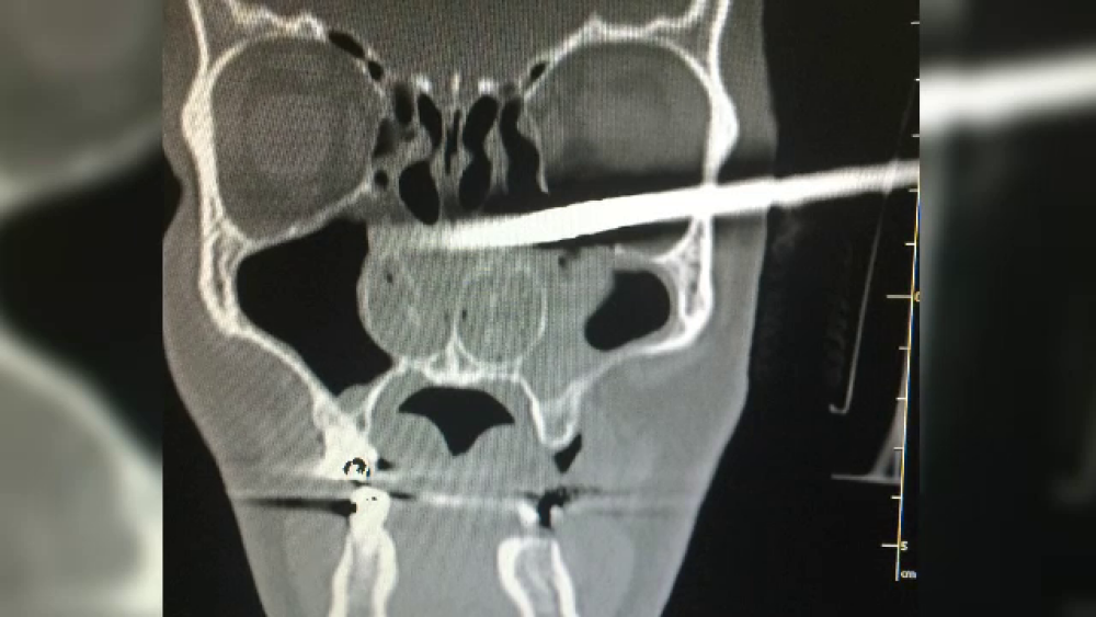 Un barbat din Polonia a ajuns constient la spital cu un cui de 15 centimetri in craniu. Cum a decurs interventia medicala - Imaginea 1