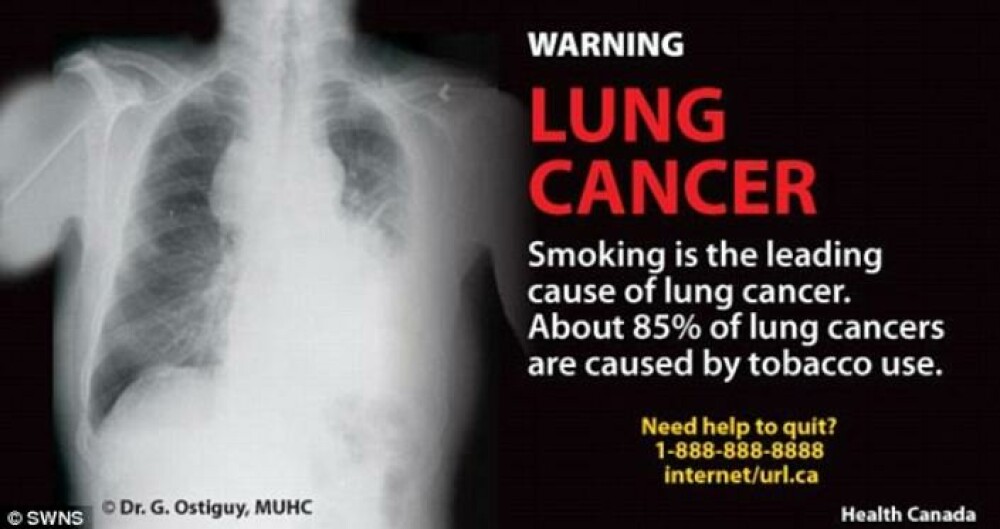 Cea mai socanta campanie anti-fumat. Bolnavi de cancer pe patul de moarte, pe pachetele de tigari - Imaginea 6